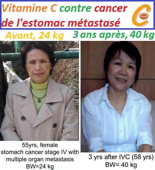 vitamin-c-intraveinous-stomac-cancer-cured
